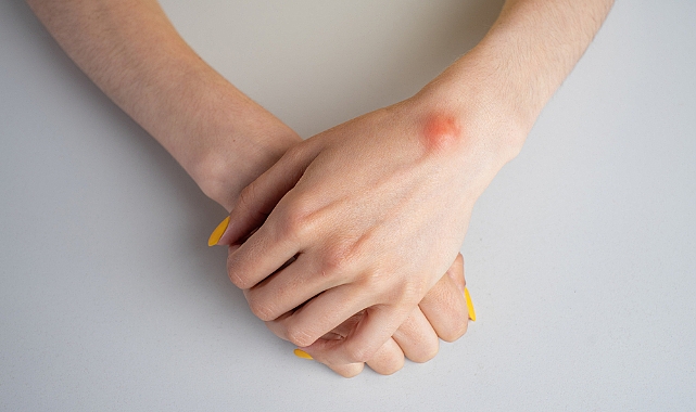 Sülük tedavisi, hacamat ve bitkisel tedavi tehlikeyi artırabiliyor!